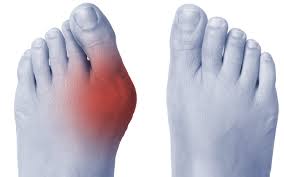 Foot deformation case